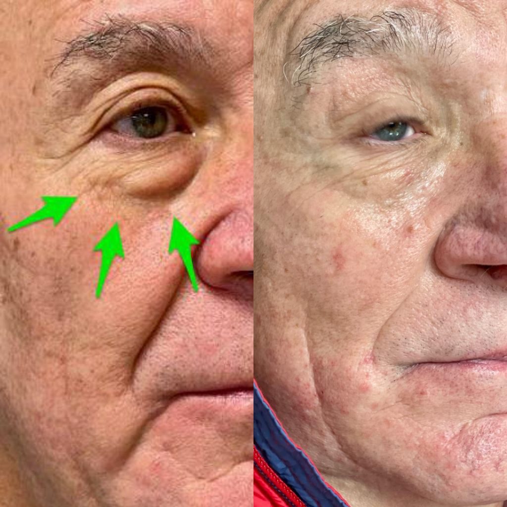 Rejuvenecimiento Facial