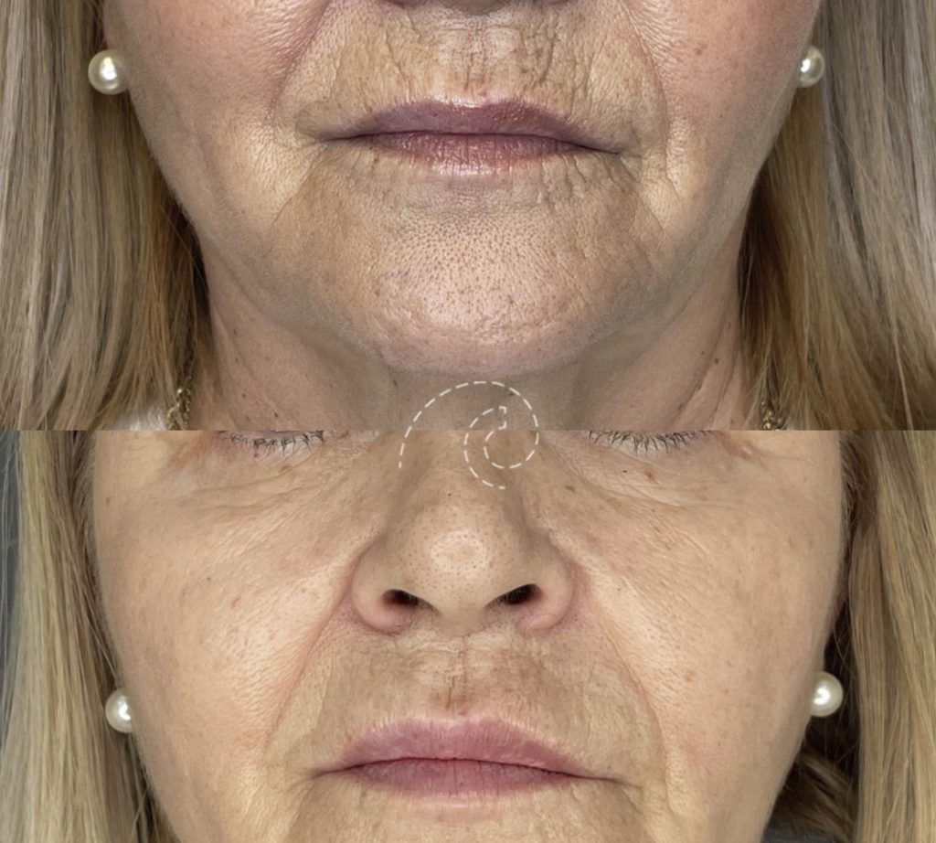Eliminar código de barras en labios Madrid Cliniem