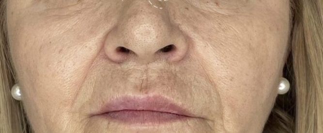 Eliminar código de barras en labios Madrid Cliniem