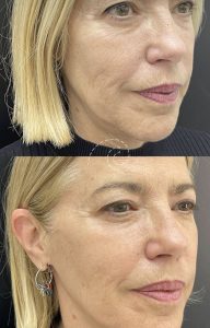 aronización facial full face rejuvenecer Madrid Cliniem