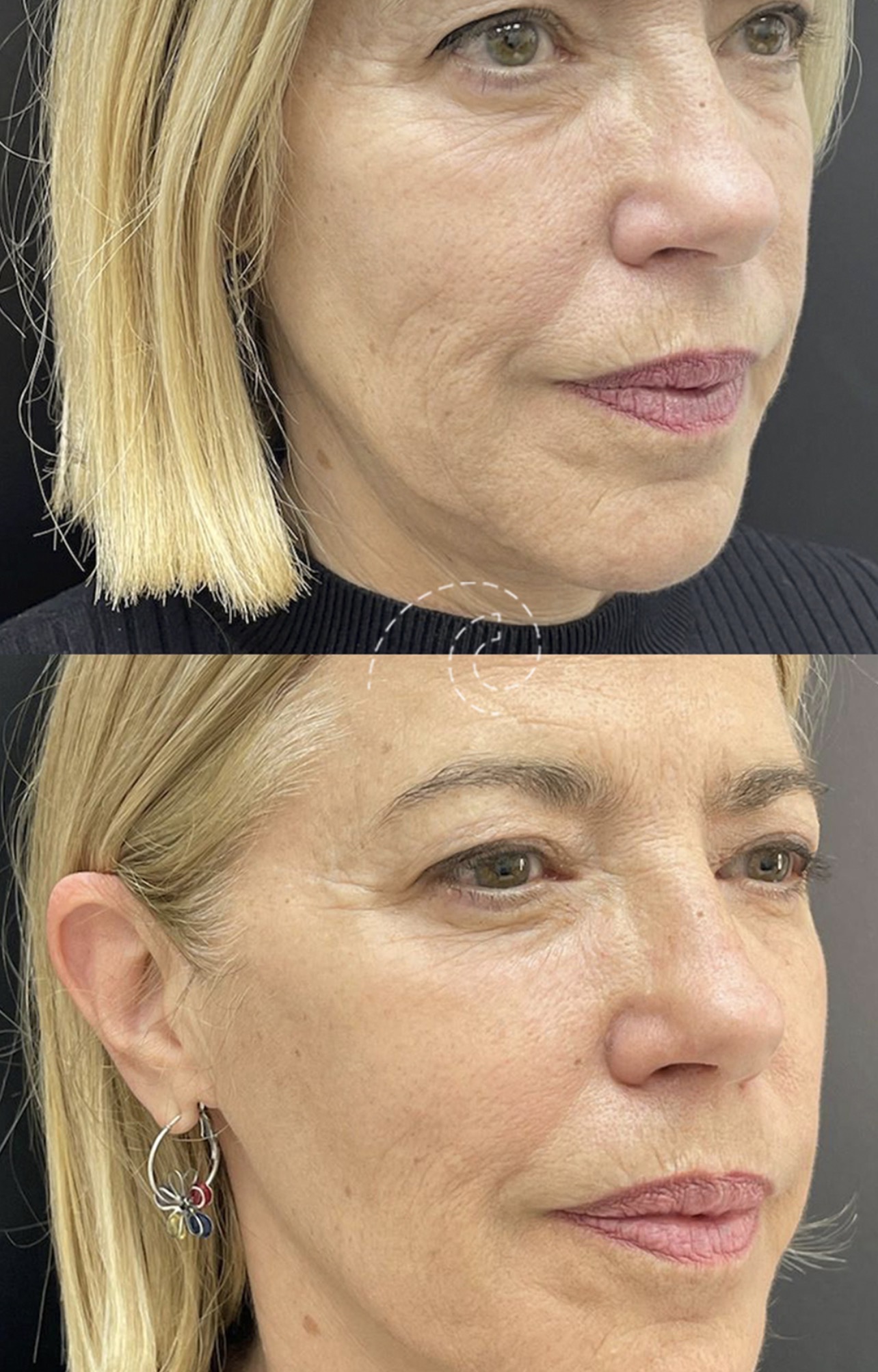 aronización facial full face rejuvenecer Madrid Cliniem