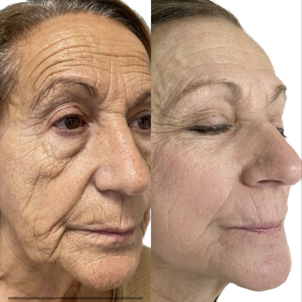 Rejuvenecimiento Facial