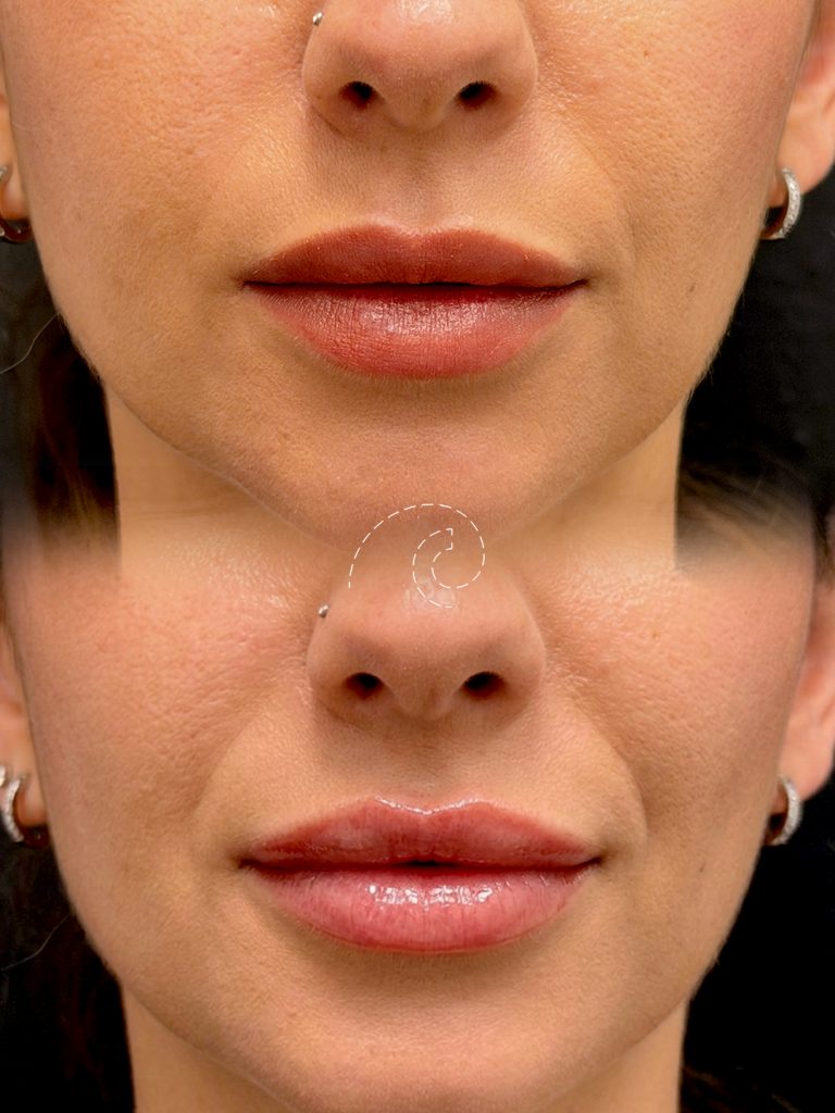 AUMENTO DE LABIOS