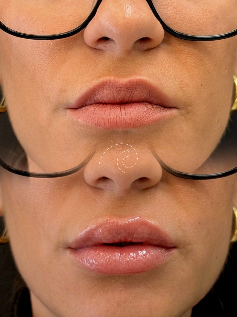 AUMENTO DE LABIOS
