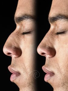 rinoplastia corregir nariz Madrid Cliniem