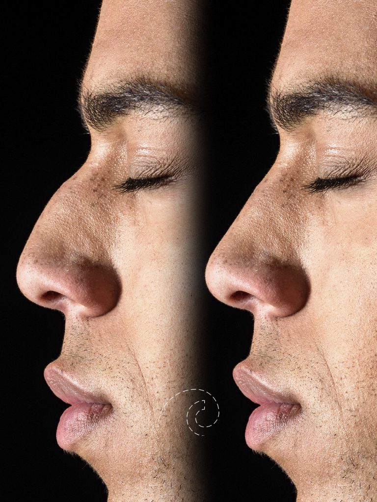 Rinomodelación: Resultados Naturales sin Cirugía