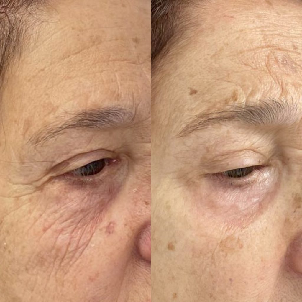 Rejuvenecimiento Facial
