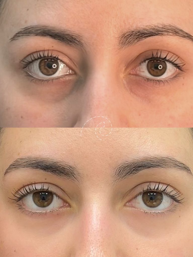 Ácido hialurónico para ojeras: tratamiento efectivo para rejuvenecer tu mirada