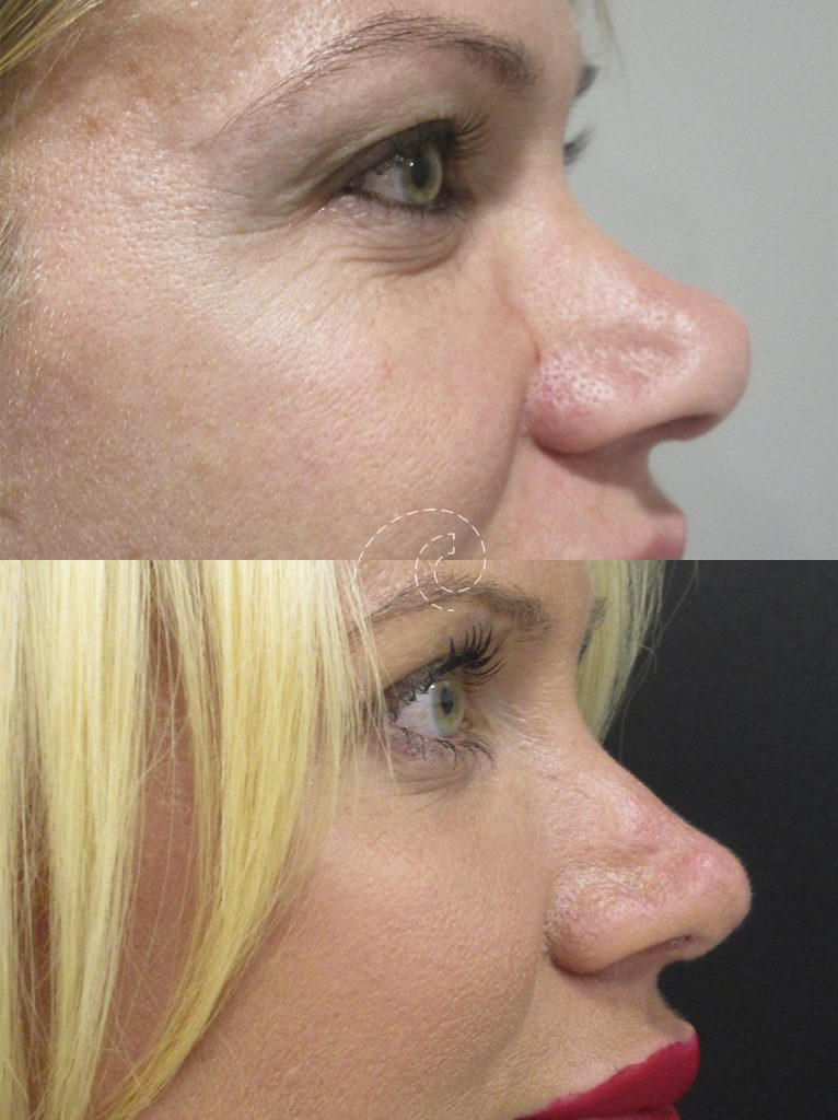 Rinoplastia ultrasónica