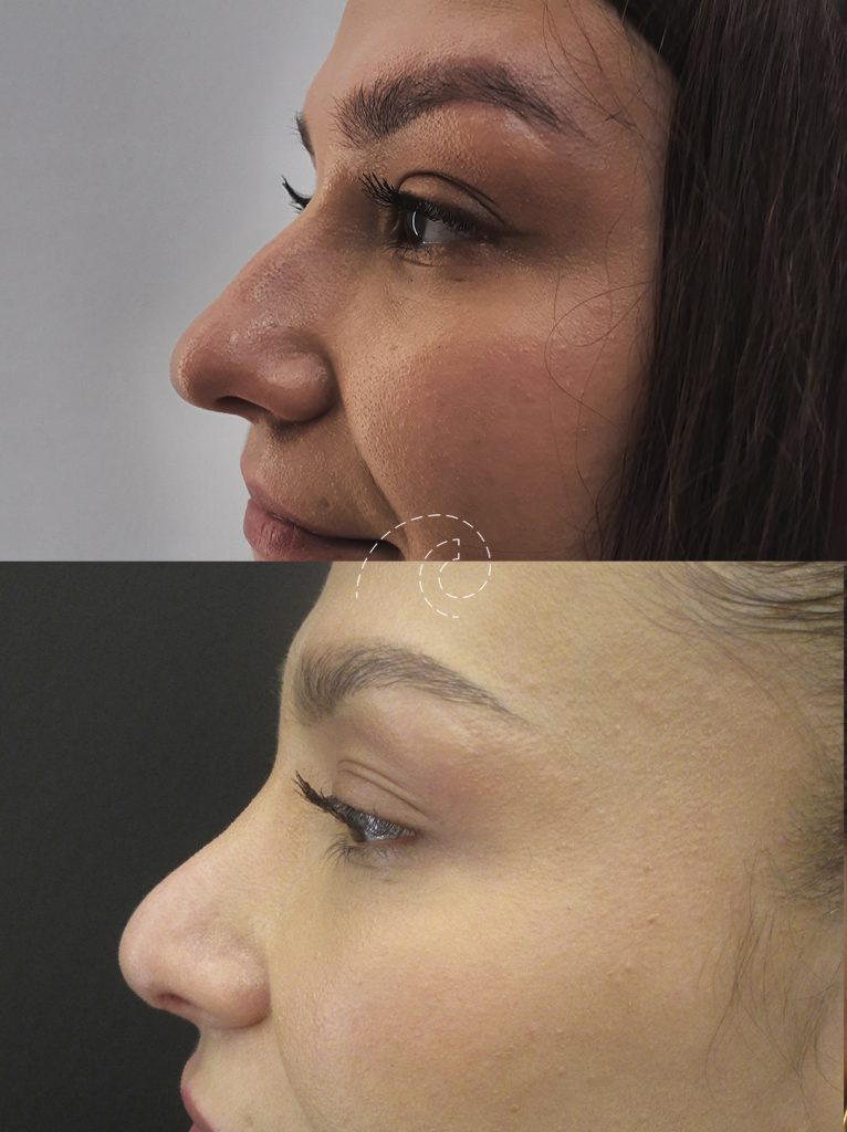 Rinoplastia ultrasónica
