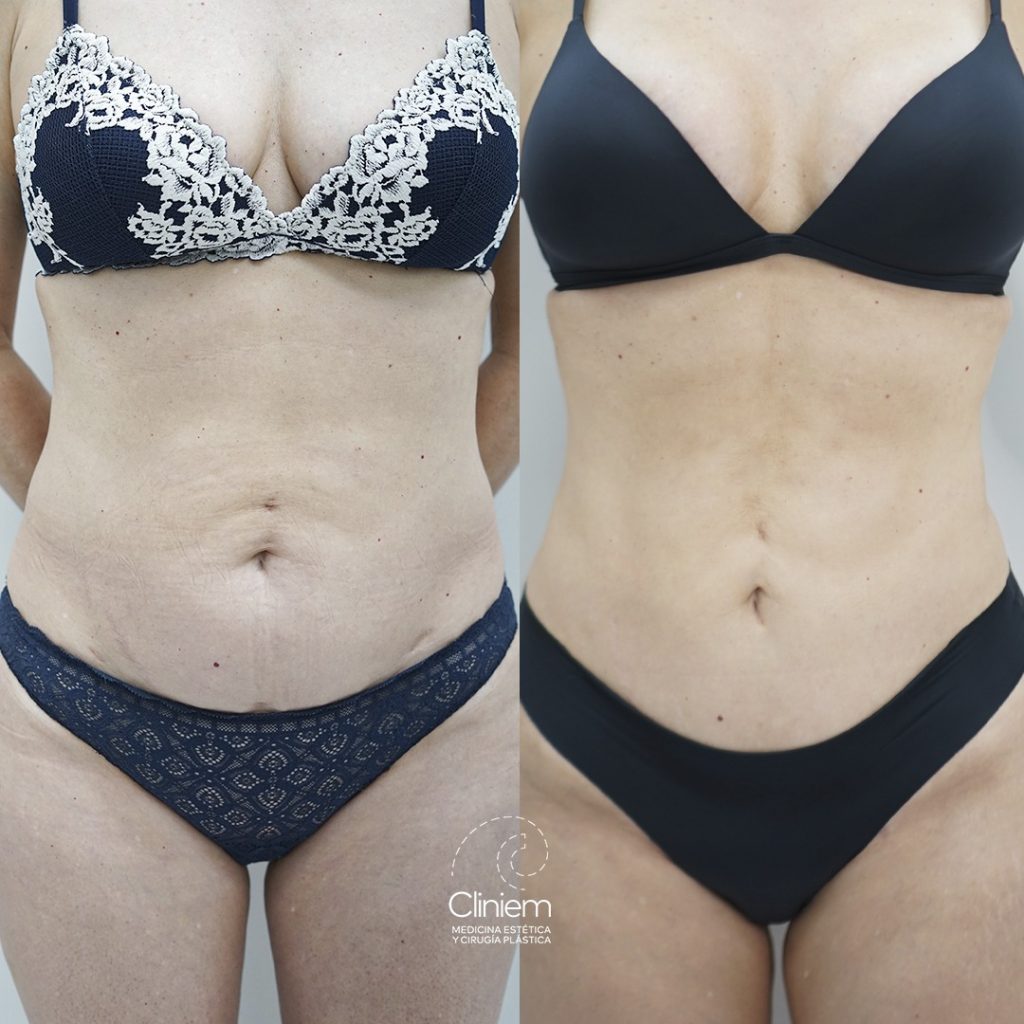 MINI ABDOMINOPLASTIA