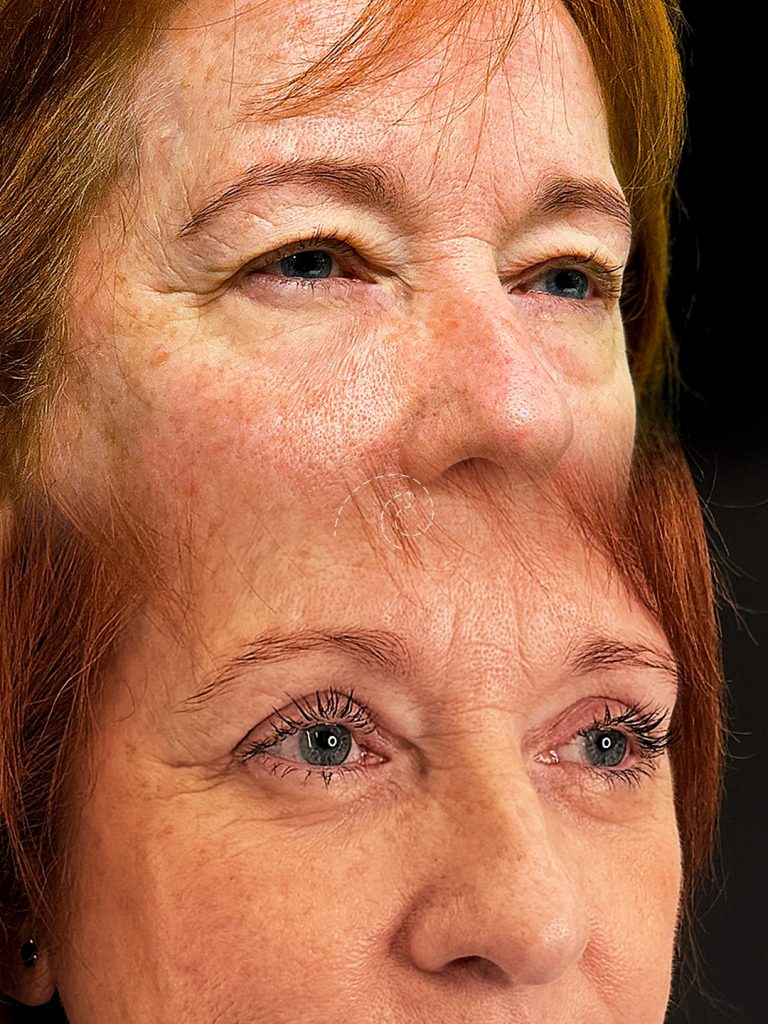Blefaroplastia superior con láser