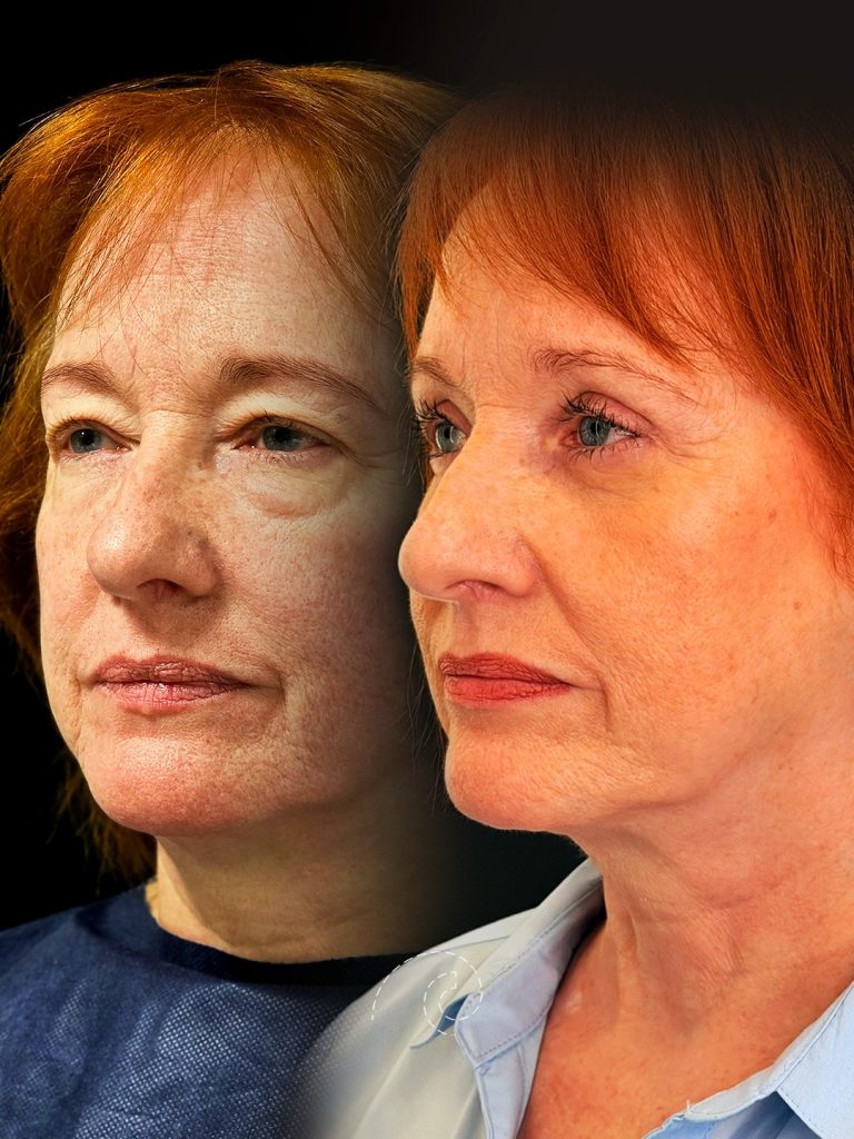 Blefaroplastia completa láser