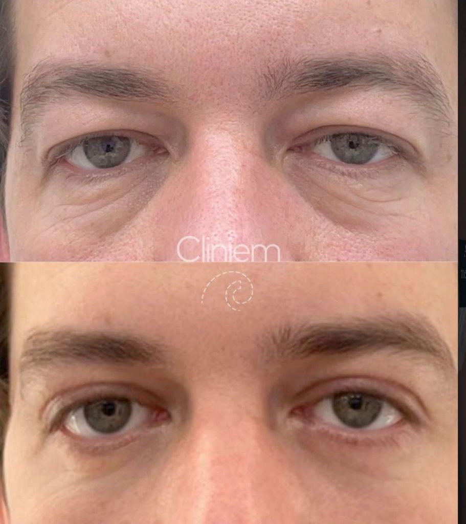 Blefaroplastia superior con láser