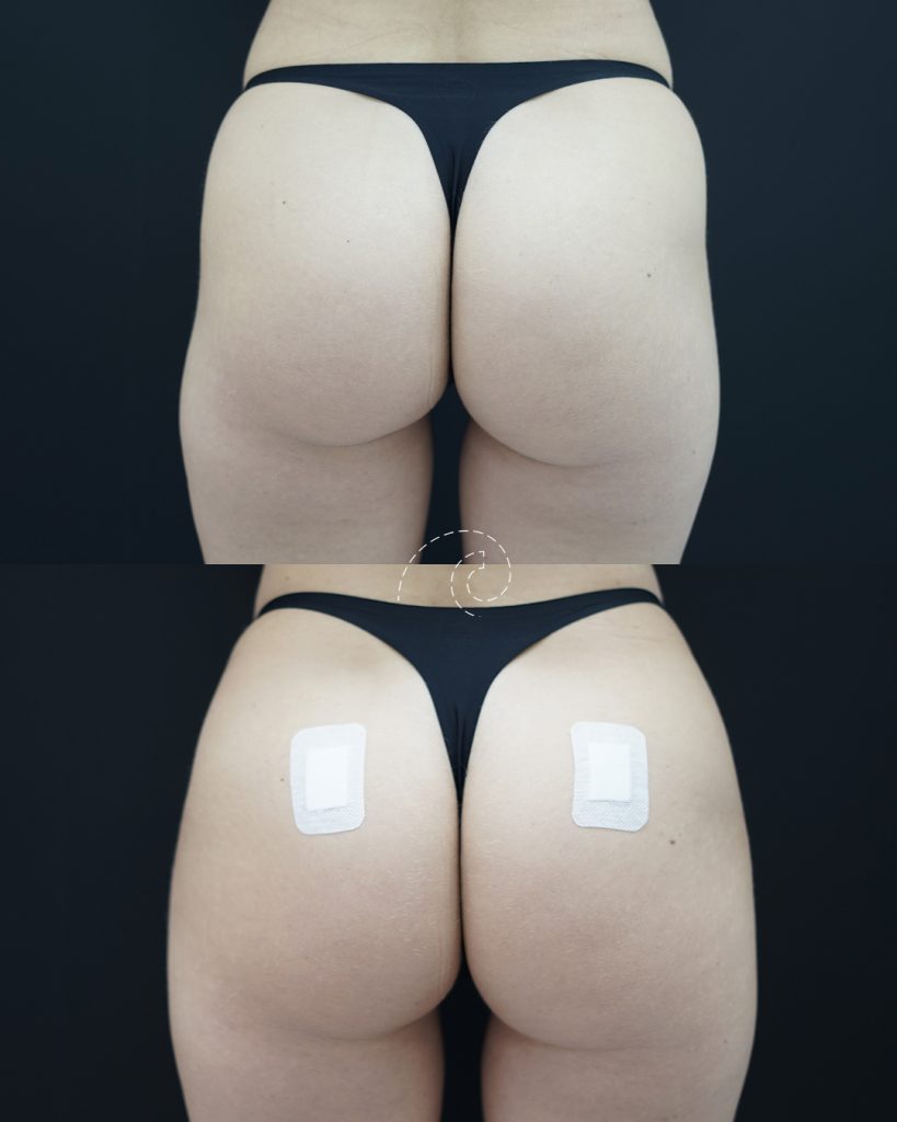 Lipotransferencia