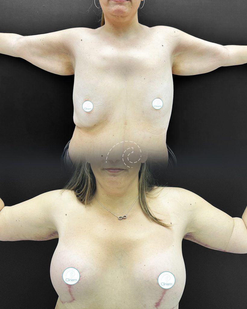 Braquioplastia 