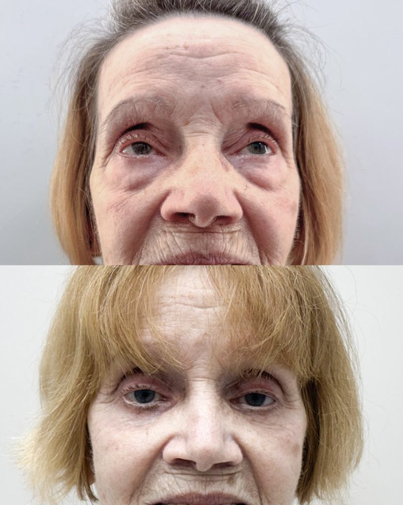 Blefaroplastia inferior con láser