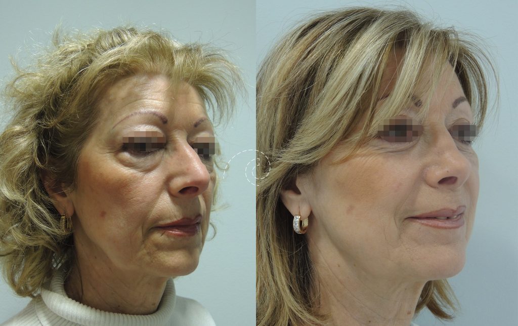Blefaroplastia inferior con láser