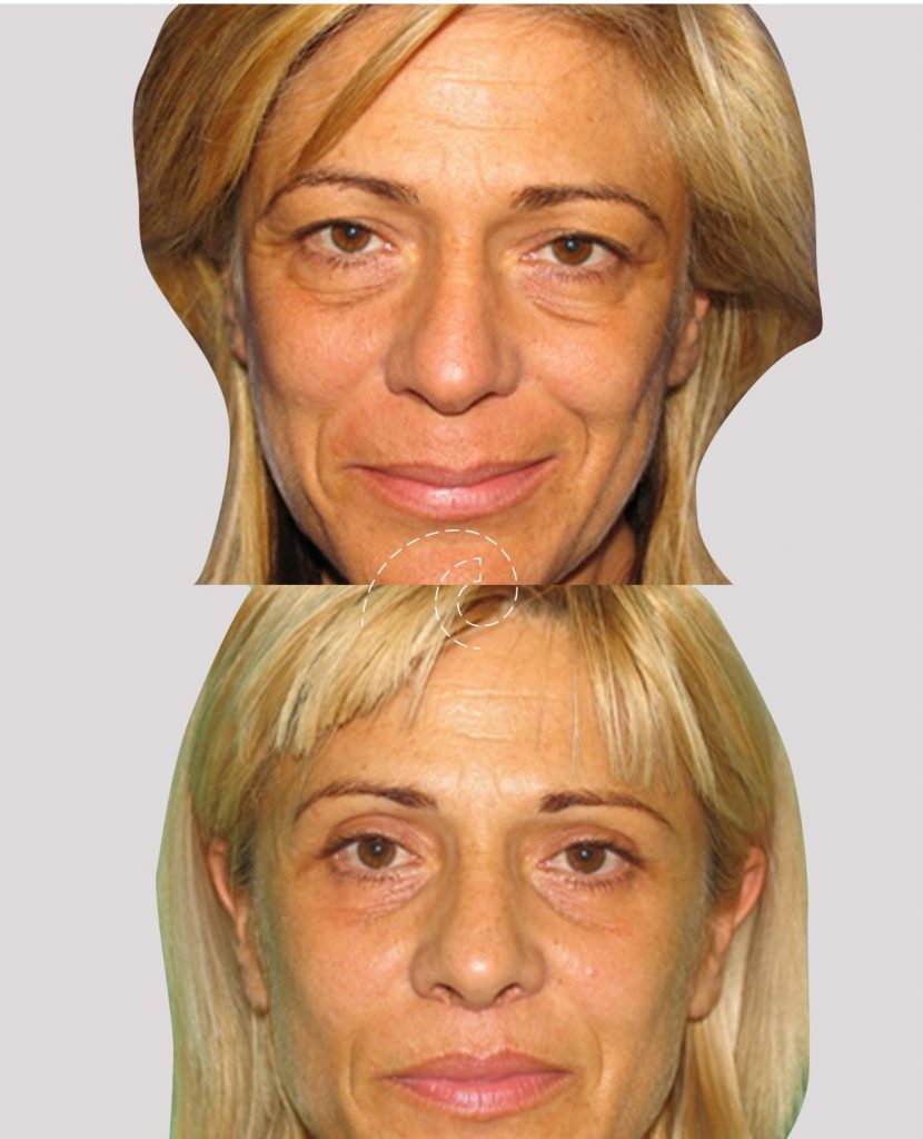 Blefaroplastia completa láser