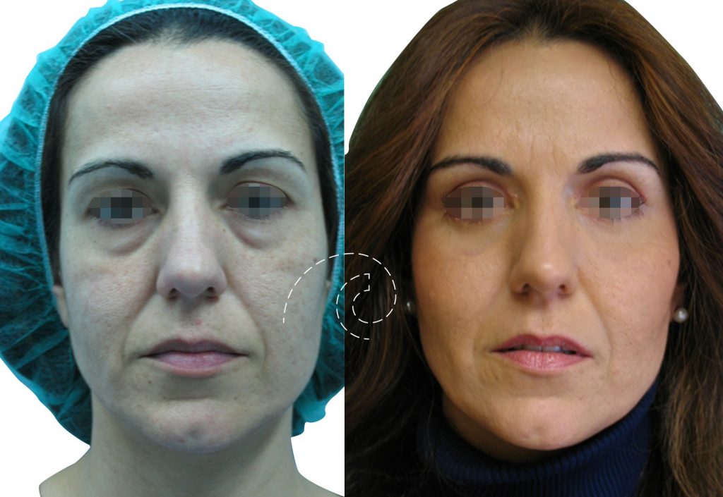 Blefaroplastia inferior con láser