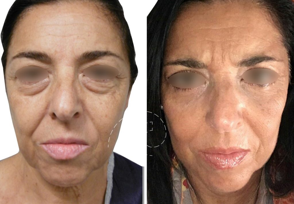 Blefaroplastia inferior con láser