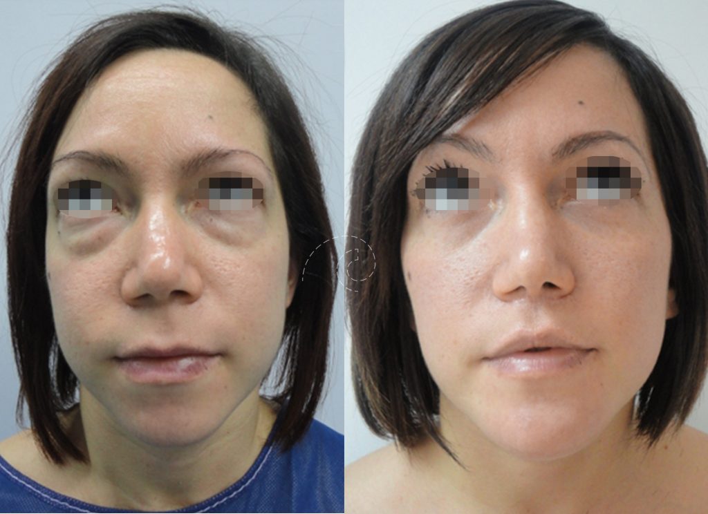 Blefaroplastia inferior con láser