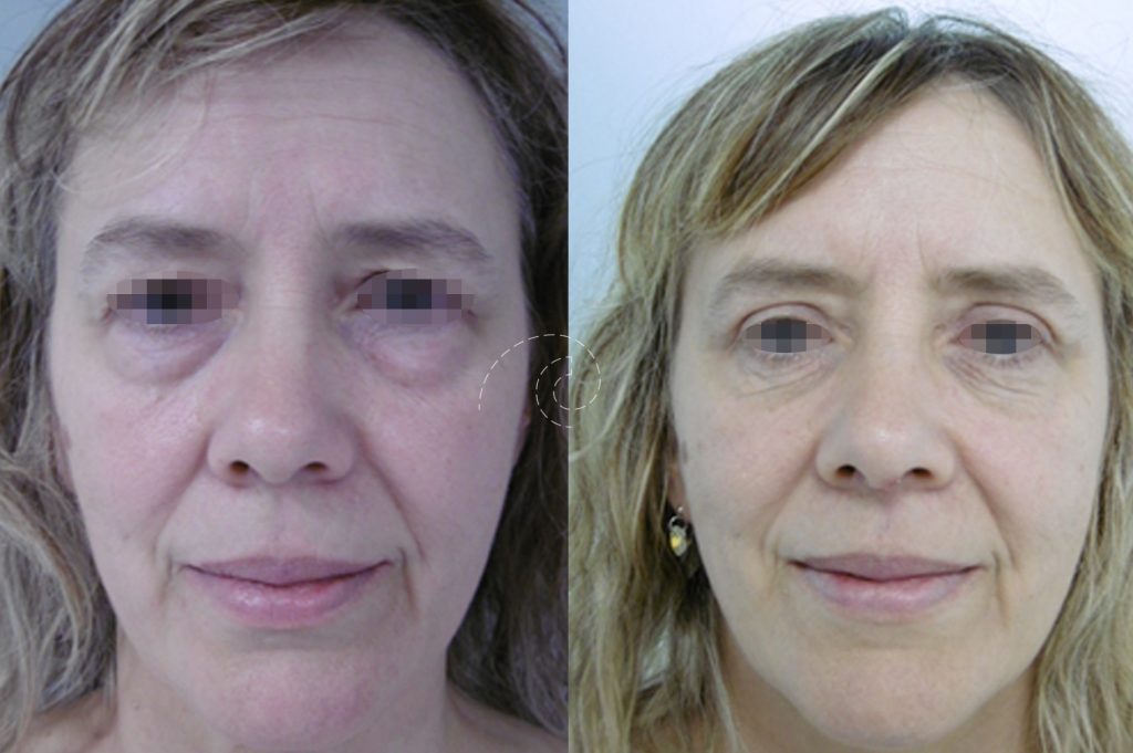 Blefaroplastia inferior con láser