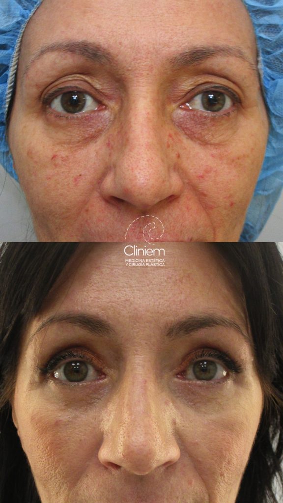 Blefaroplastia completa láser