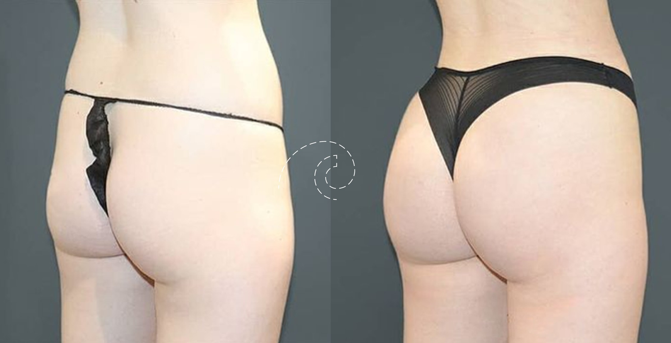 bodytite Madrid Cliniem liposucción con radiofrecuencia