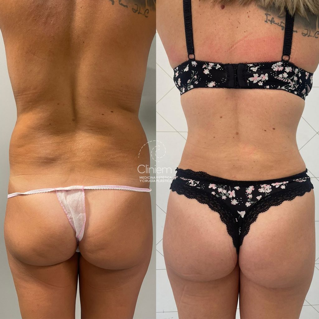 Lipotransferencia
