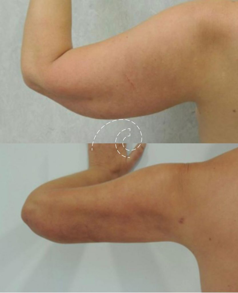Braquioplastia 