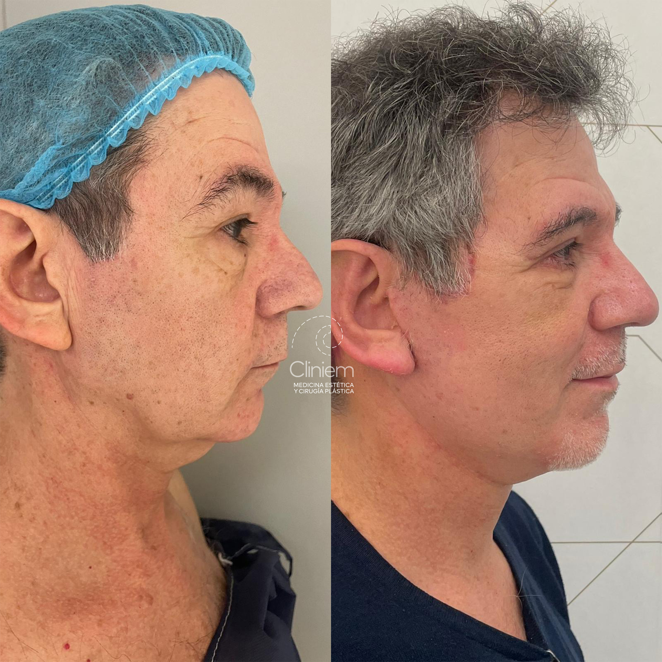 eliminar flacidez facial tratamientos en Madrid Cliniem