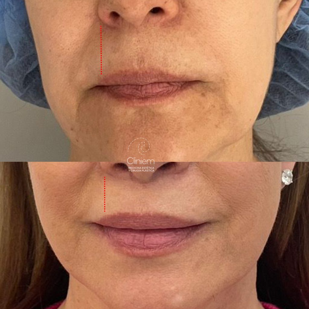 LIP LIFT 