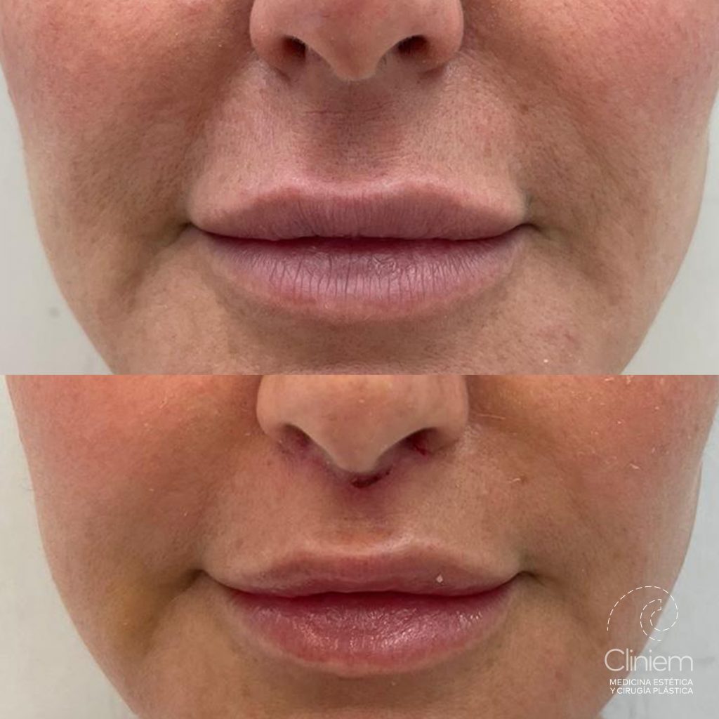 LIP LIFT 