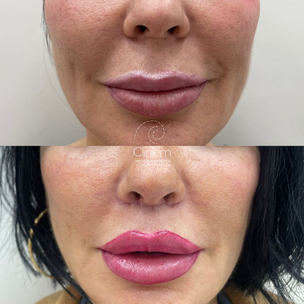 LIP LIFT 