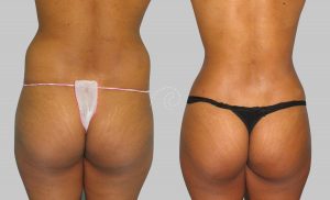 Cirugía estética Body Tite Madrid Cliniem