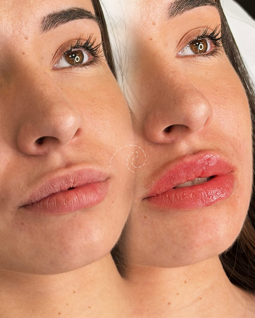 AUMENTO DE LABIOS