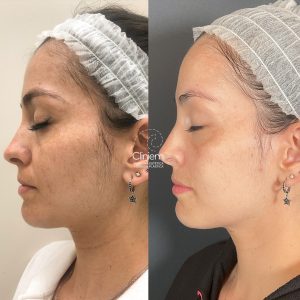 eliminar melasma Madrid Cliniem