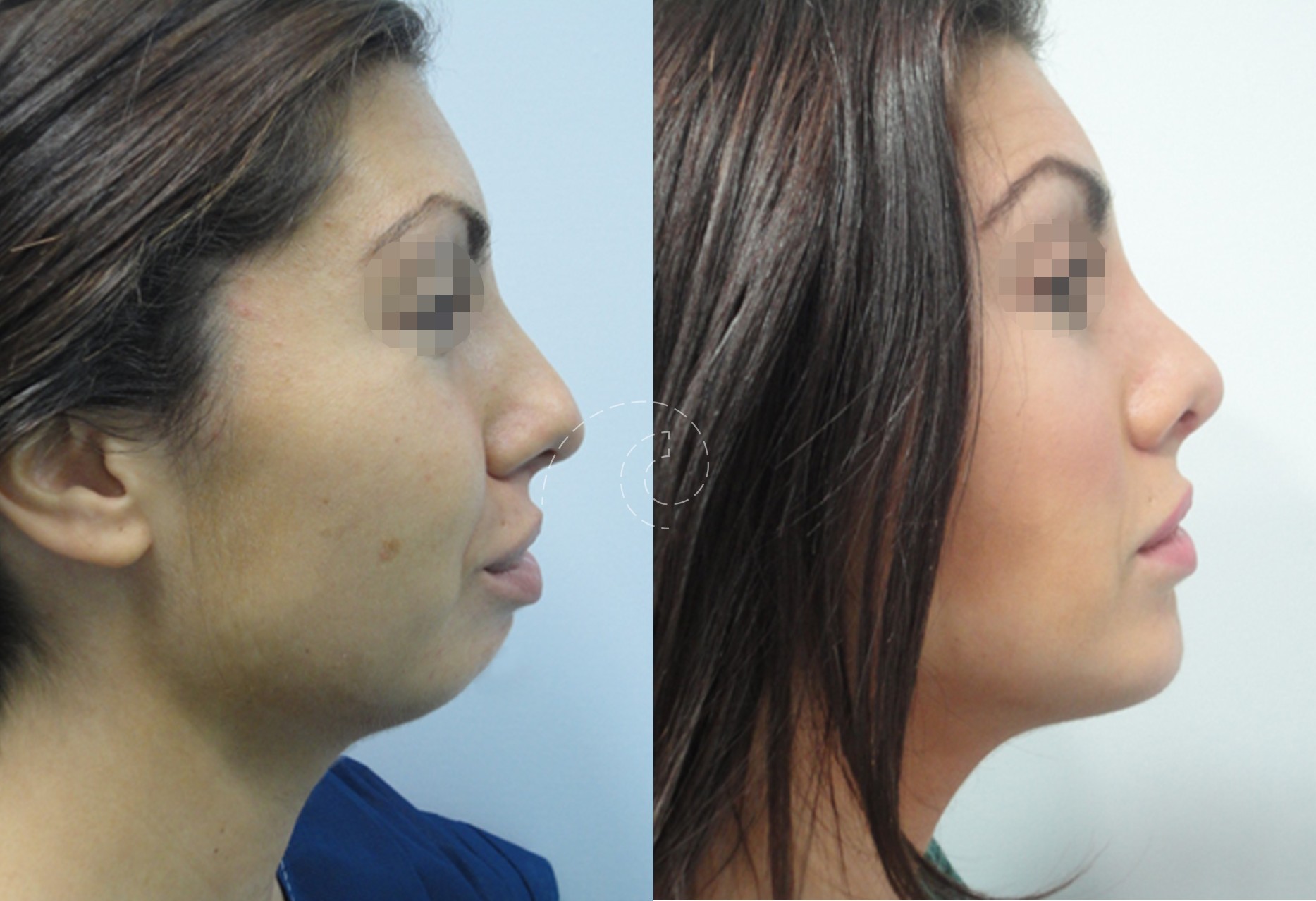mentoplastia Madrid Cliniem