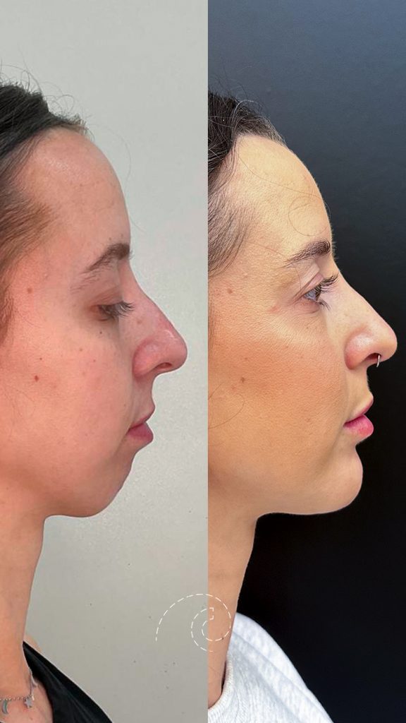 Mentoplastia