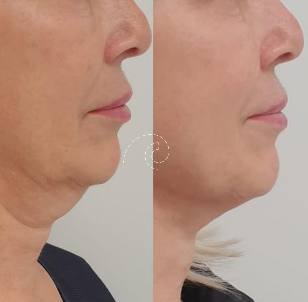 FACETITE