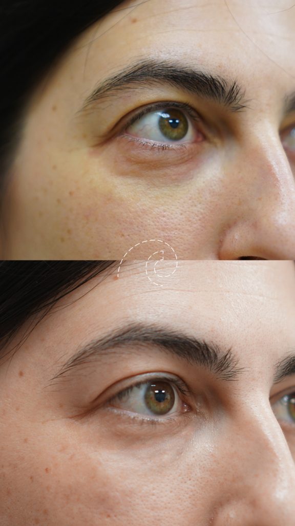 Ácido hialurónico para ojeras: tratamiento efectivo para rejuvenecer tu mirada
