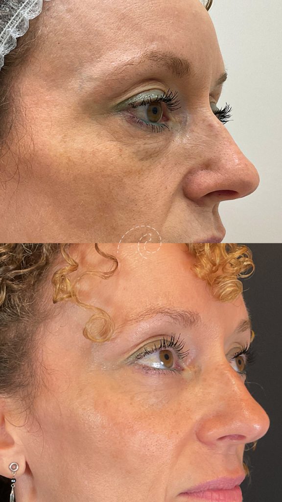 Ácido hialurónico para ojeras: tratamiento efectivo para rejuvenecer tu mirada