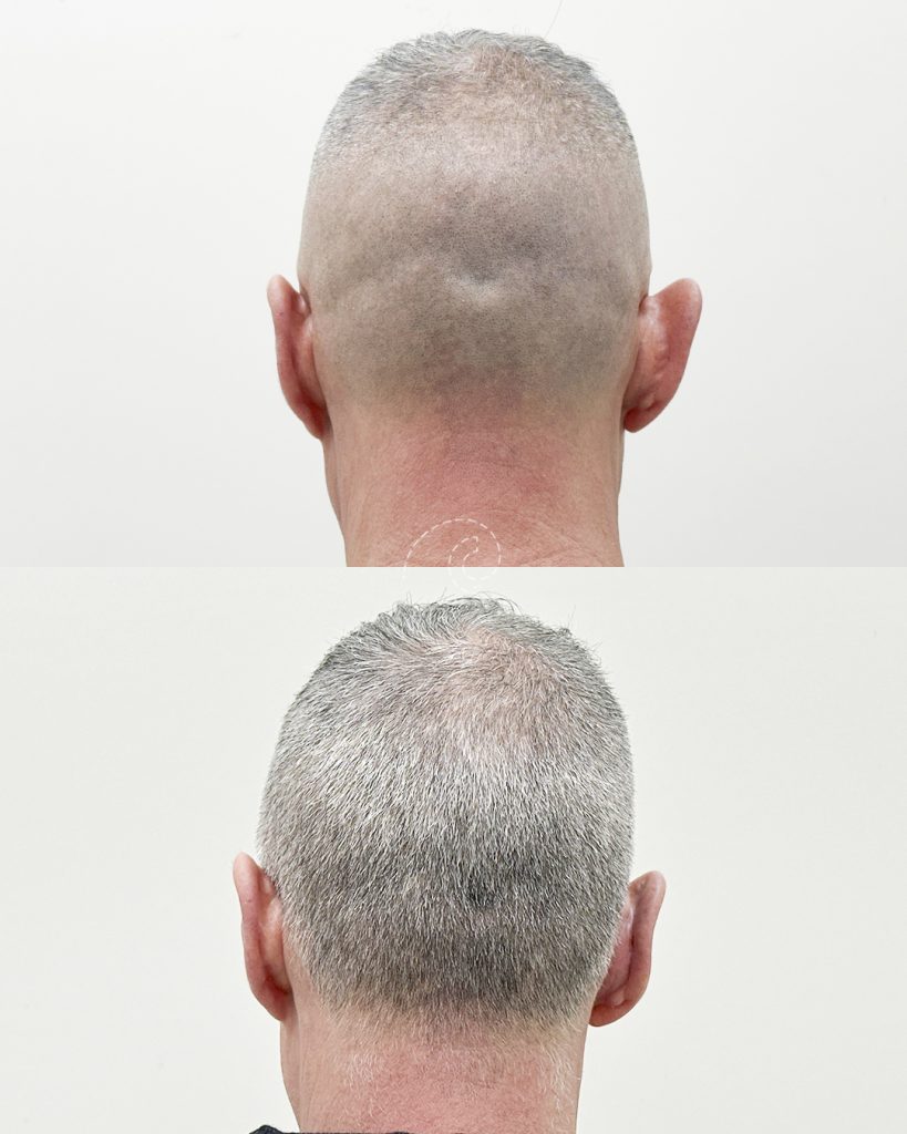 OTOPLASTIA