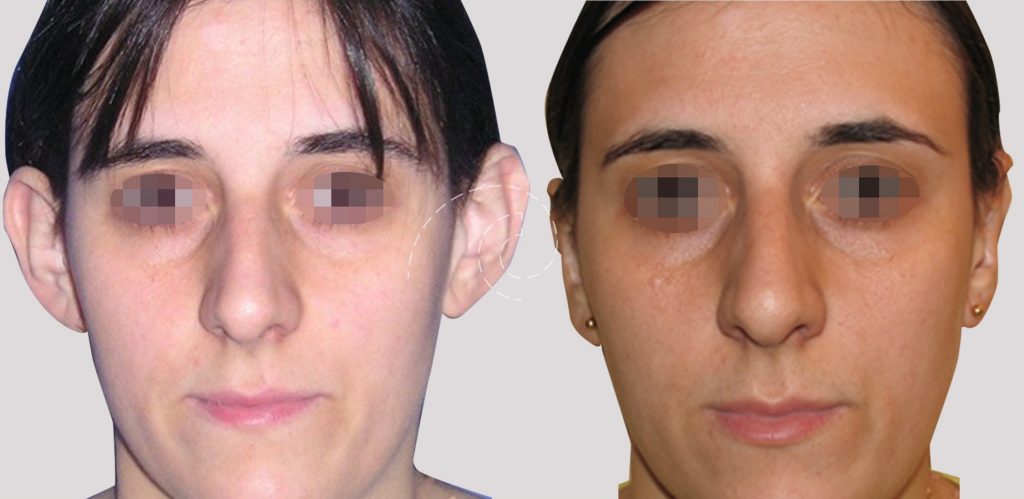 OTOPLASTIA