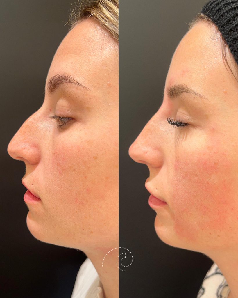 Rinomodelación: Resultados Naturales sin Cirugía
