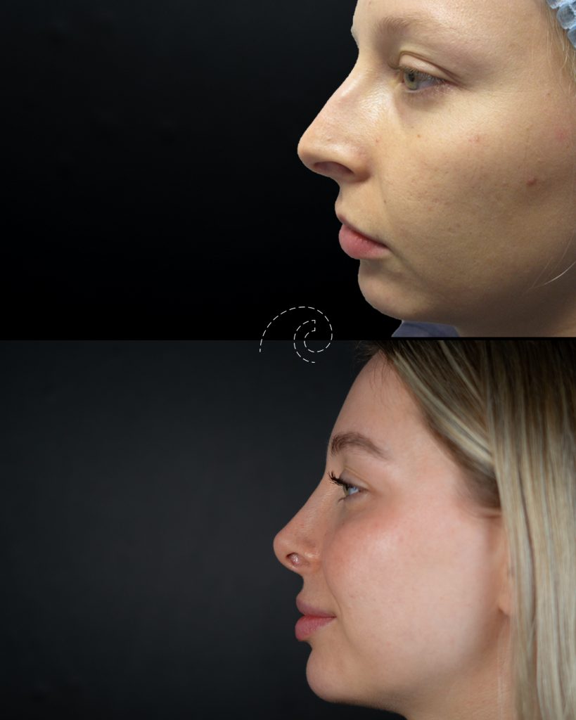 Rinoplastia ultrasónica