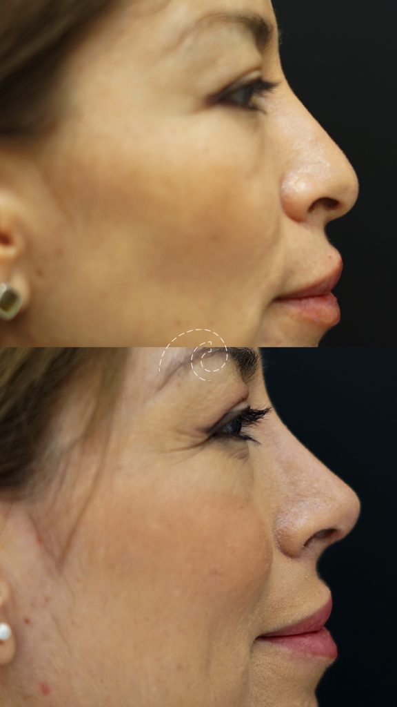Rinoplastia ultrasónica