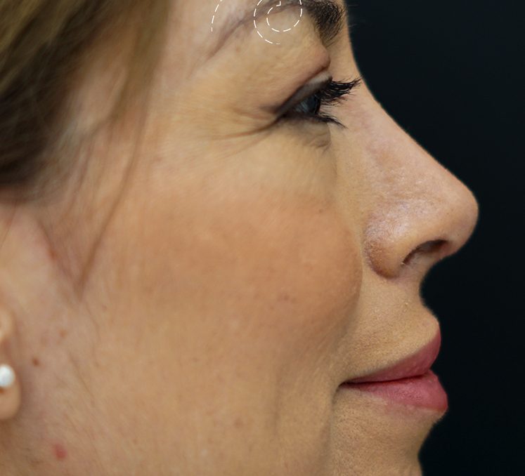 rinoplastia Madrid Cliniem