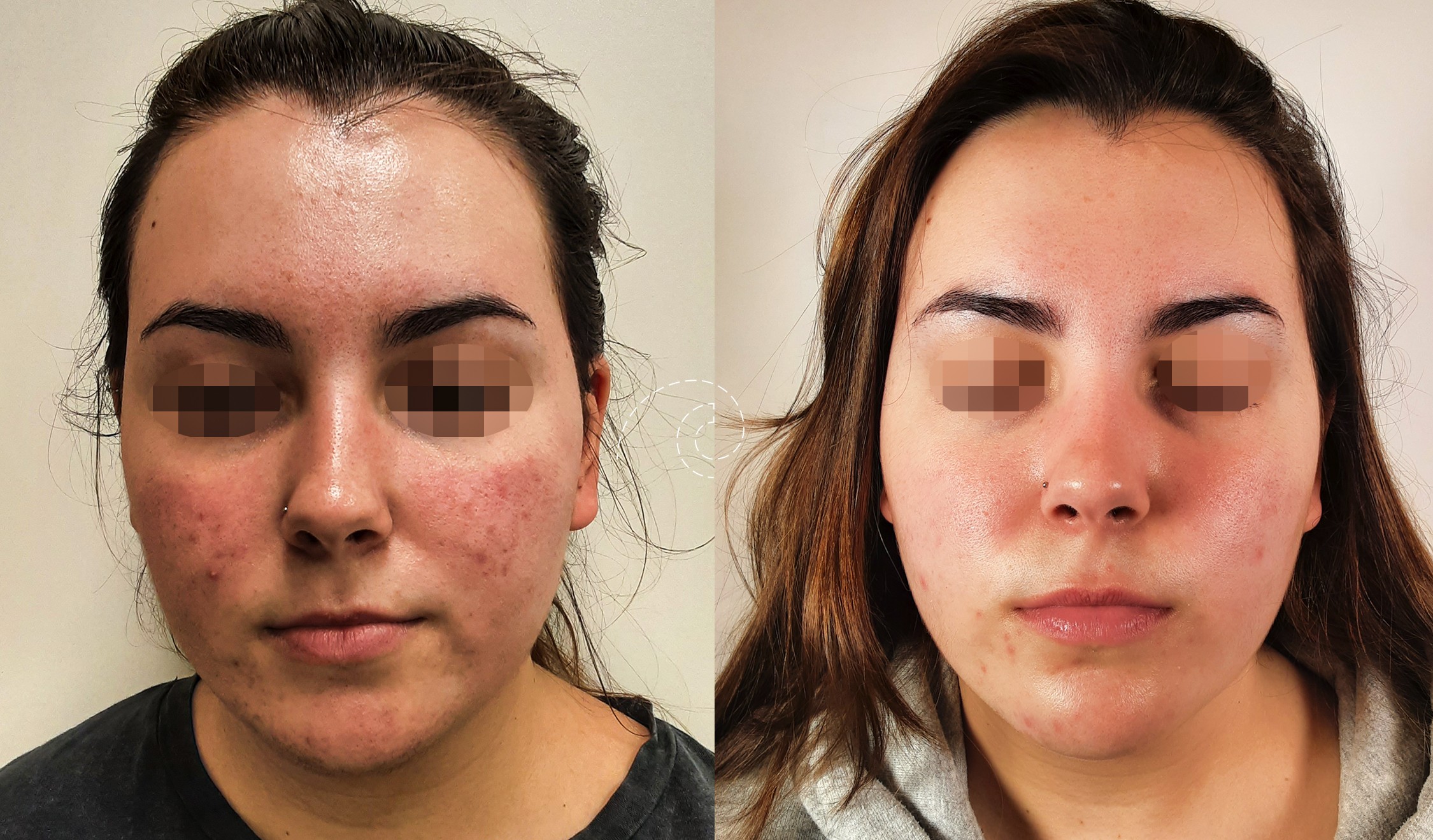 Antes y después de tratamiento de rosácea en Madrid Cliniem